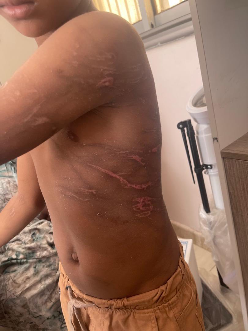 نواكشوط : سجن رجل عذب أطفاله وحرقهم في مناطق حساسة